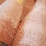 Σοκ σε ελληνικό νοσοκομείο: 20χρονη κοπέλα μπήκε για επέμβαση και βγήκε με εγκαύματα τρίτου βαθμού