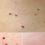 Κόκκινες κουκκίδες στο δέρμα: Τι μπορεί να σημαίνουν και πότε πρέπει να απευθυνθείτε σε γιατρό