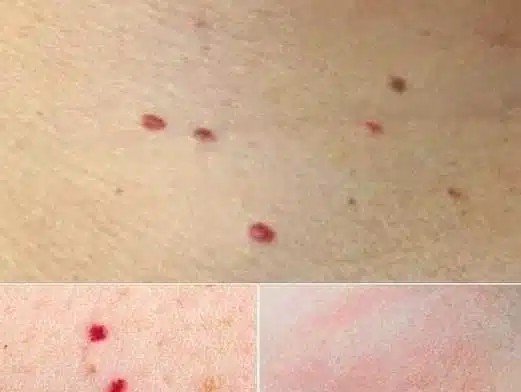 Κόκκινες κουκκίδες στο δέρμα: Τι μπορεί να σημαίνουν και πότε πρέπει να απευθυνθείτε σε γιατρό