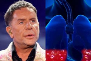 Με αφορμή τον Μαζωνάκη: Τι είναι το πνευμονικό οίδημα που έδειξε η ιατροδικαστική – Πώς γεμίζουν οι πνεύμονες με υγρό, πότε απειλείται η ζωή