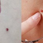 Γιατί εμφανίζονται κόκκινες ελιές στο δέρμα – Τι λέει η επιστήμη