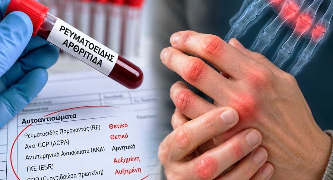 Ρευματοειδής αρθρίτιδα: Τα «σιωπηλά» σημάδια στο αίμα που μπορεί να εμφανίζονται χρόνια πριν από τους πόνους